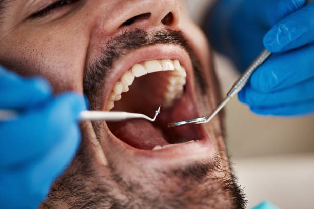 Best Emergency Wisdom Tooth Extraction in Riverside, AL